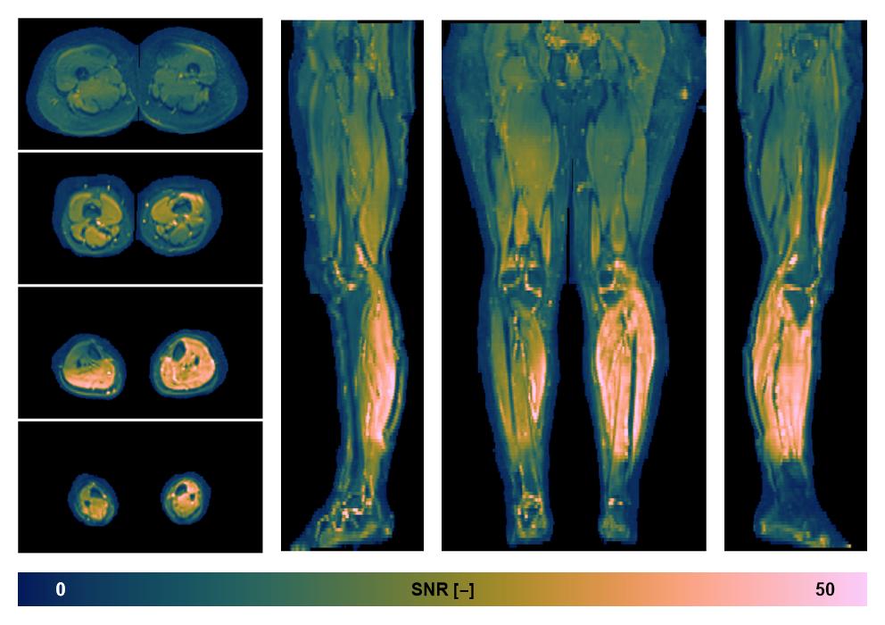 SNR distribution of the unweighted diffusion data.